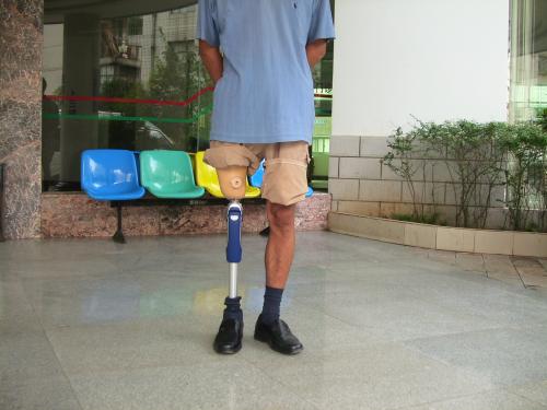 安裝假肢多久做一次訓(xùn)練比較好?需要多長時間?(圖1) 假肢